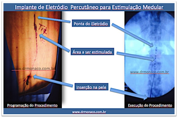 programação da cirurgia percutânea e imagem da radioscopia intra-operatória - Dr. Bernardo de Monaco - Percutaneous Spinal Cord Stimulation - Chronic Pain - SCS